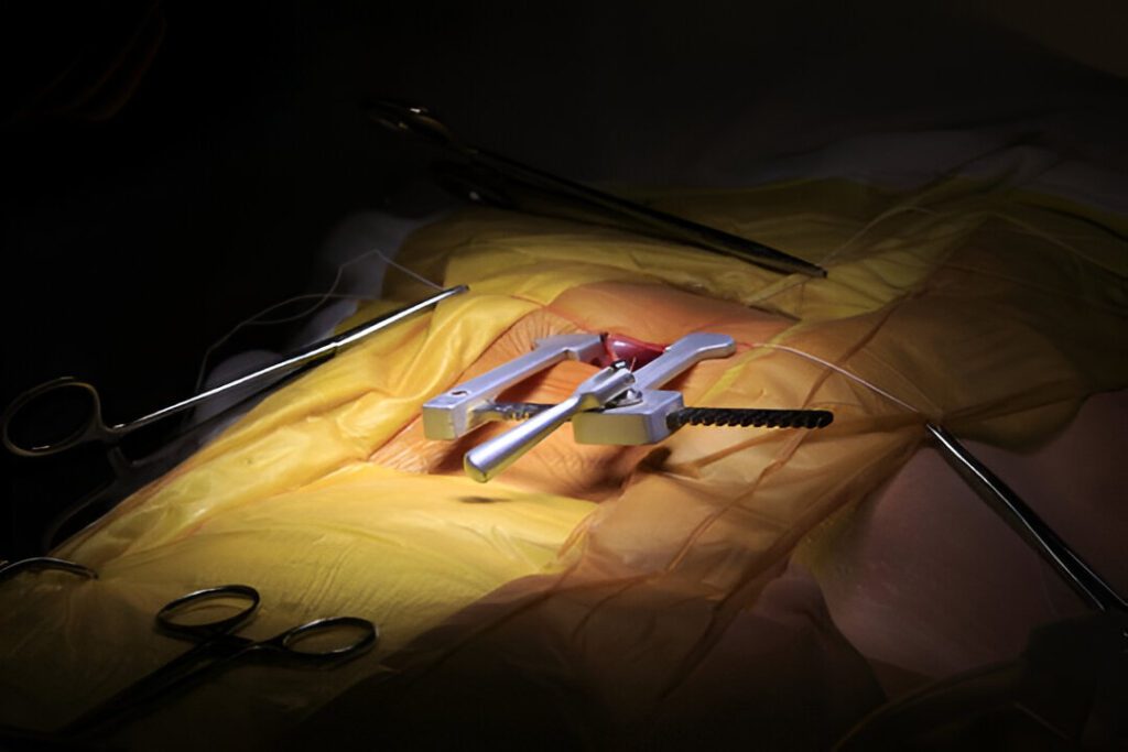 Finochietto Rib Spreader in Thoracic Surgery