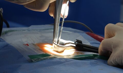 Close-up detailed view of spinal surgery procedure in hospital operating room with surgical tools and instruments