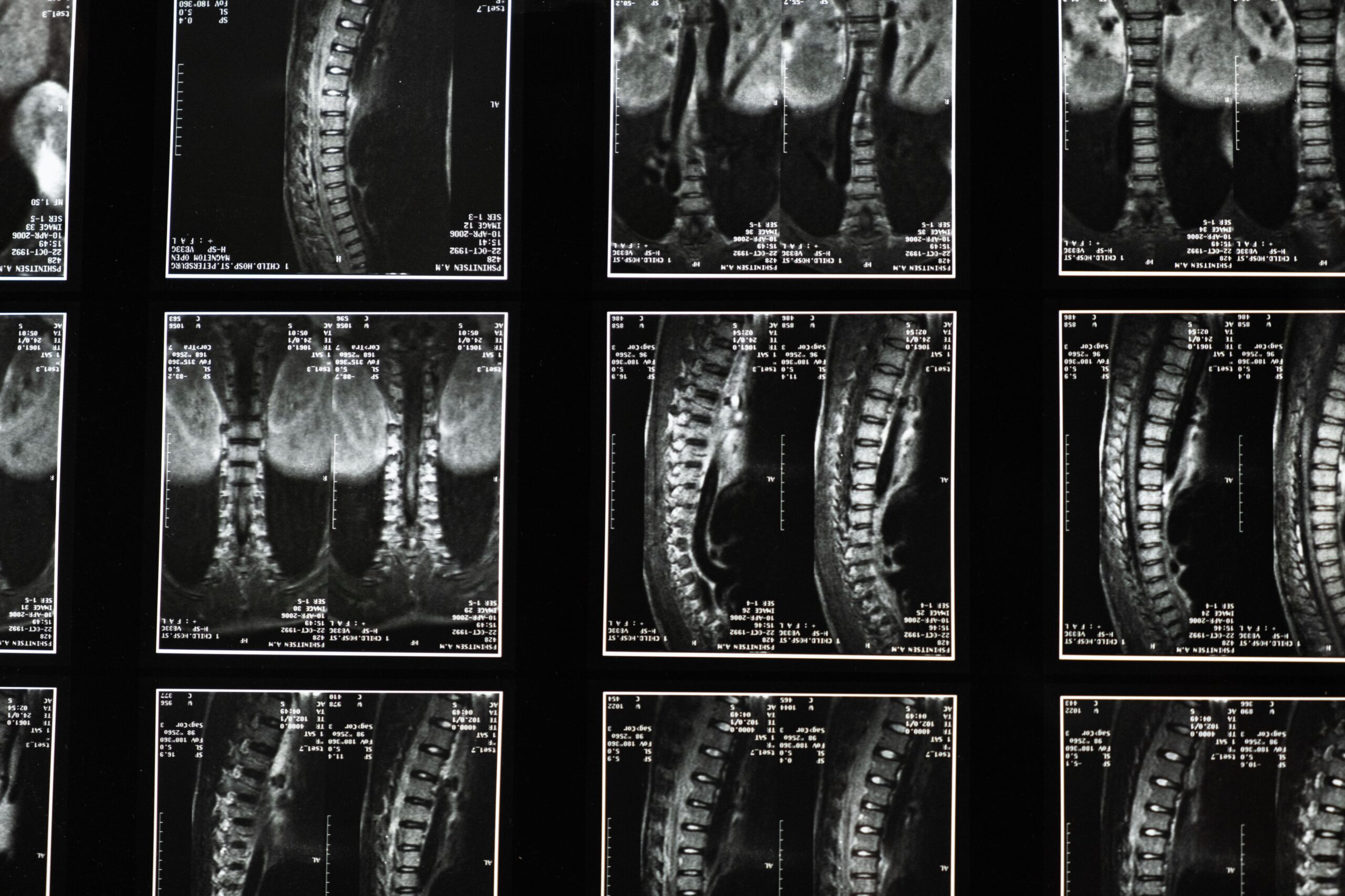 Person holding lower back in pain showing spinal instability requiring surgical treatment and stabilization