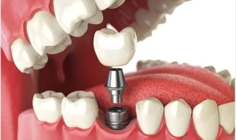 Dental-Implantology