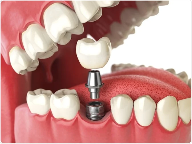 Dental-Implantology
